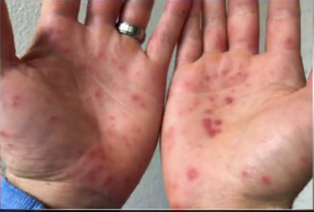 http://kron4.com/2016/10/26/video-hand-foot-and-mouth-disease-popping-up-at-college-campuses-nationwide/